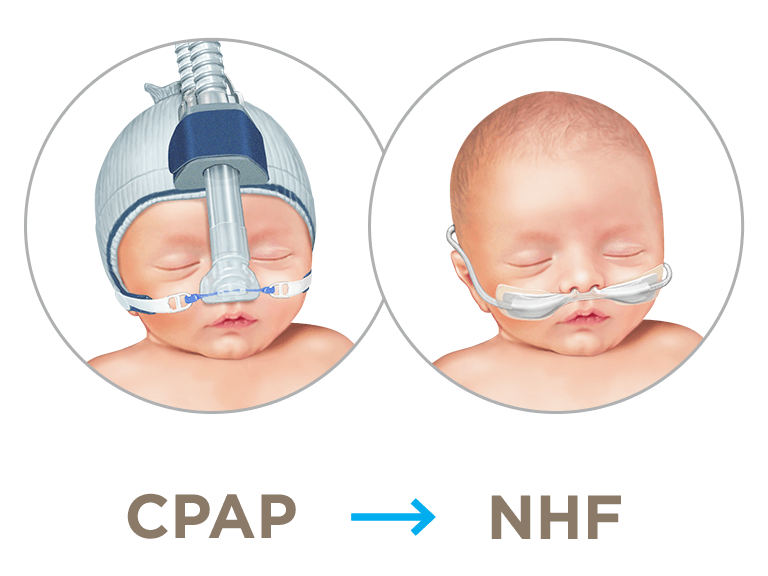 NHF as primary treatment