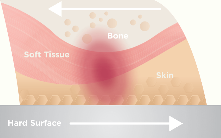 Friction can affect the formation of pressure ulcers