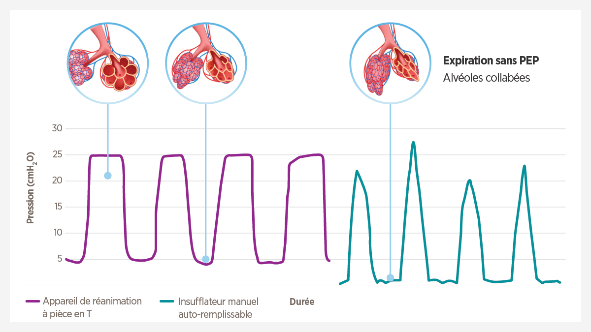 La réanimation du nouveau-né protège des lésions pulmonaires