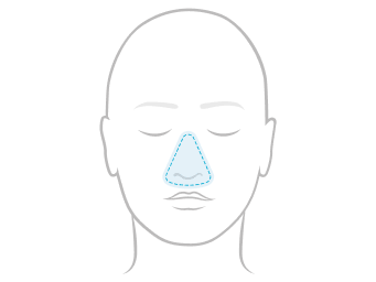 Line illustration of a face showing nasal over-the-nose mask coverage