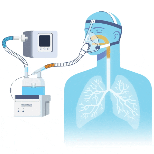 Illustration of a patient mechanically ventilated with a heated humidifier