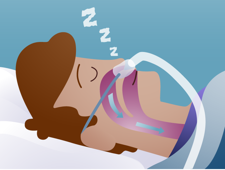 How Does CPAP Work & What Does it Do? Fisher & Paykel Fisher