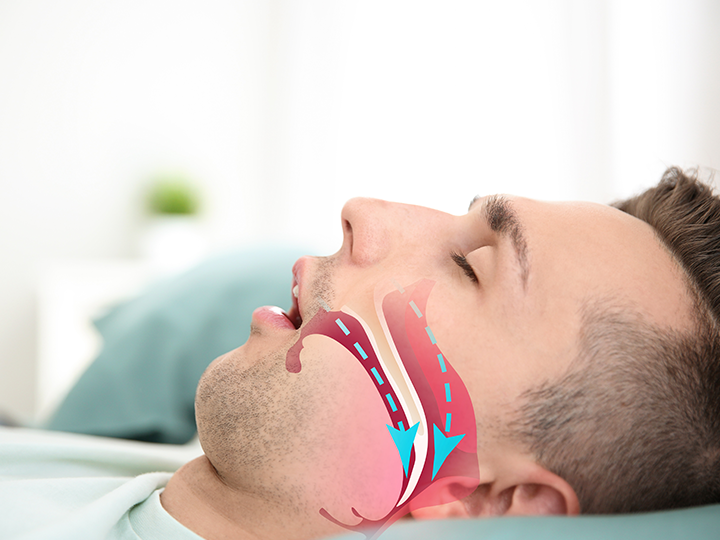 What Does a CPAP Mask Do? Fisher & Paykel Fisher & Paykel Healthcare