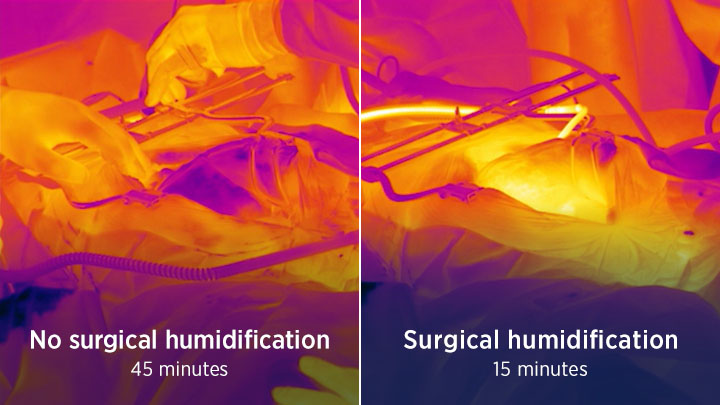 F&P HumiGard™ temperature maintenance during laparotomy
