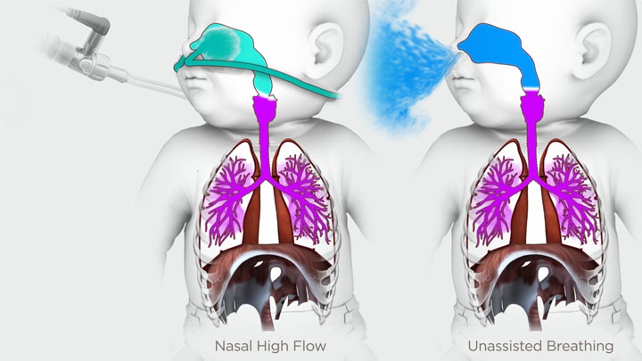 Comparison of NHF vs Unassisted Breathing