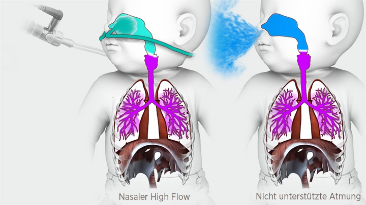 Comparison of NHF vs Unassisted Breathing