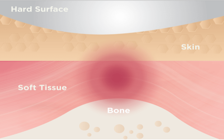 Pressure factor affects formation of pressure ulcers 