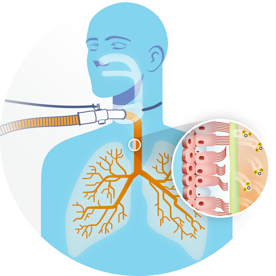 An example of an invasively ventilated patient with a tracheostomy tube and a close-up of the mucociliary transport system.