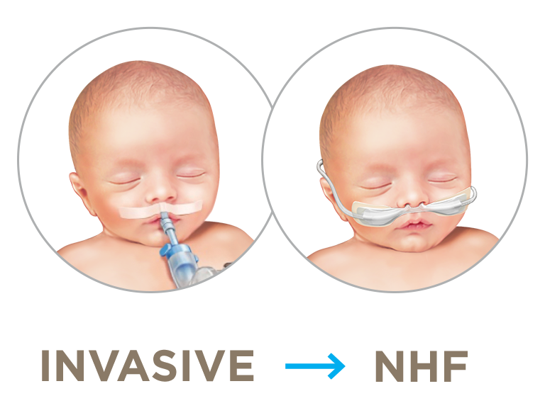 NHF as postextubation support
